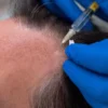 Hair Loss Treatment